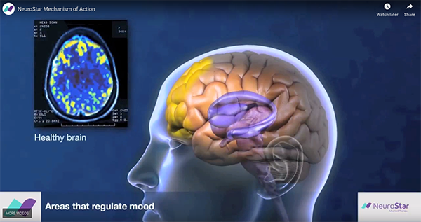 TMS depression treatment Marietta GA