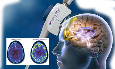 TMS depression treatment Marietta GA